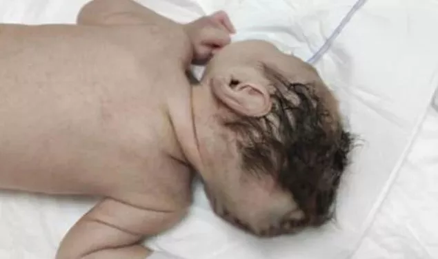 Kahramanmaraş'ta Bir Bebek, Beyninin Yarısı Kafatası Dışında Dünyaya Geldi!